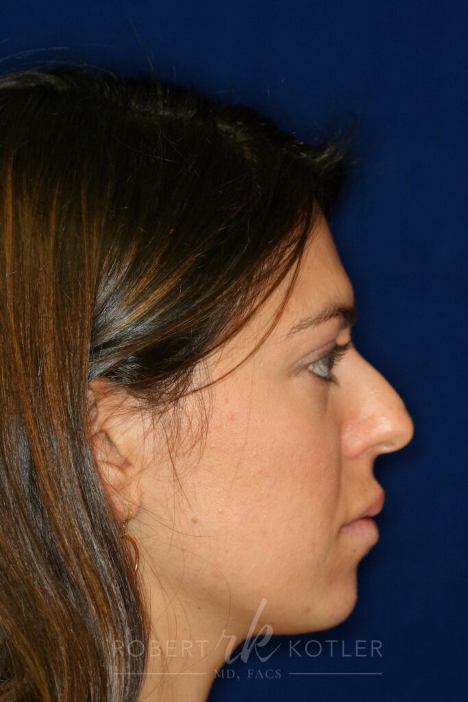 Rhinoplasty Before And After Photos Nose Job Dr Robert Kotler