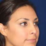 Closed Rhinoplasty - Right Profile - After Pic - Hump removal - Lowered profile - Tip enhancement - Nose elevated from lip - Rhinoplasty Surgeon in Beverly Hills