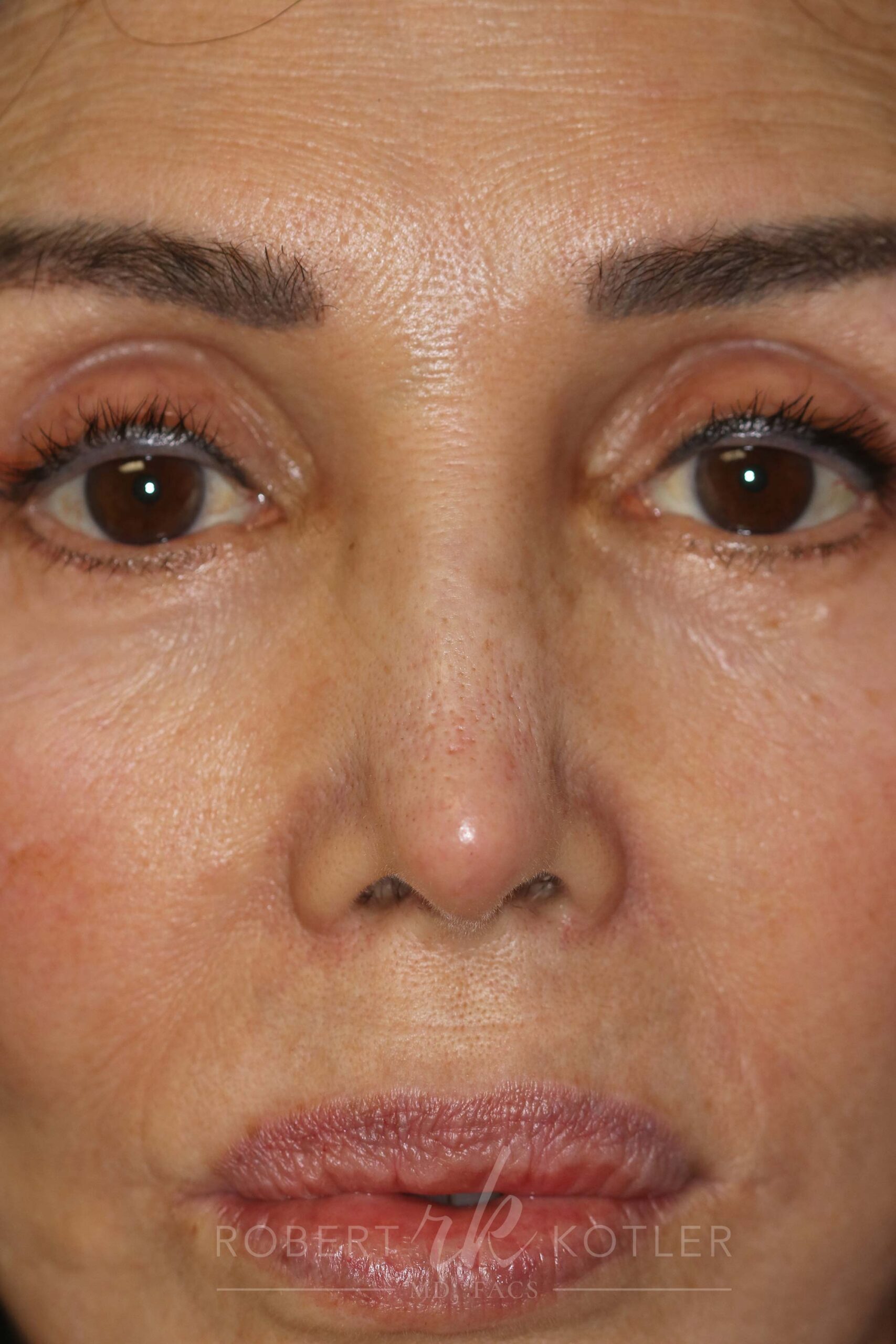 Permanent Non-Surgical Revision Rhinoplasty