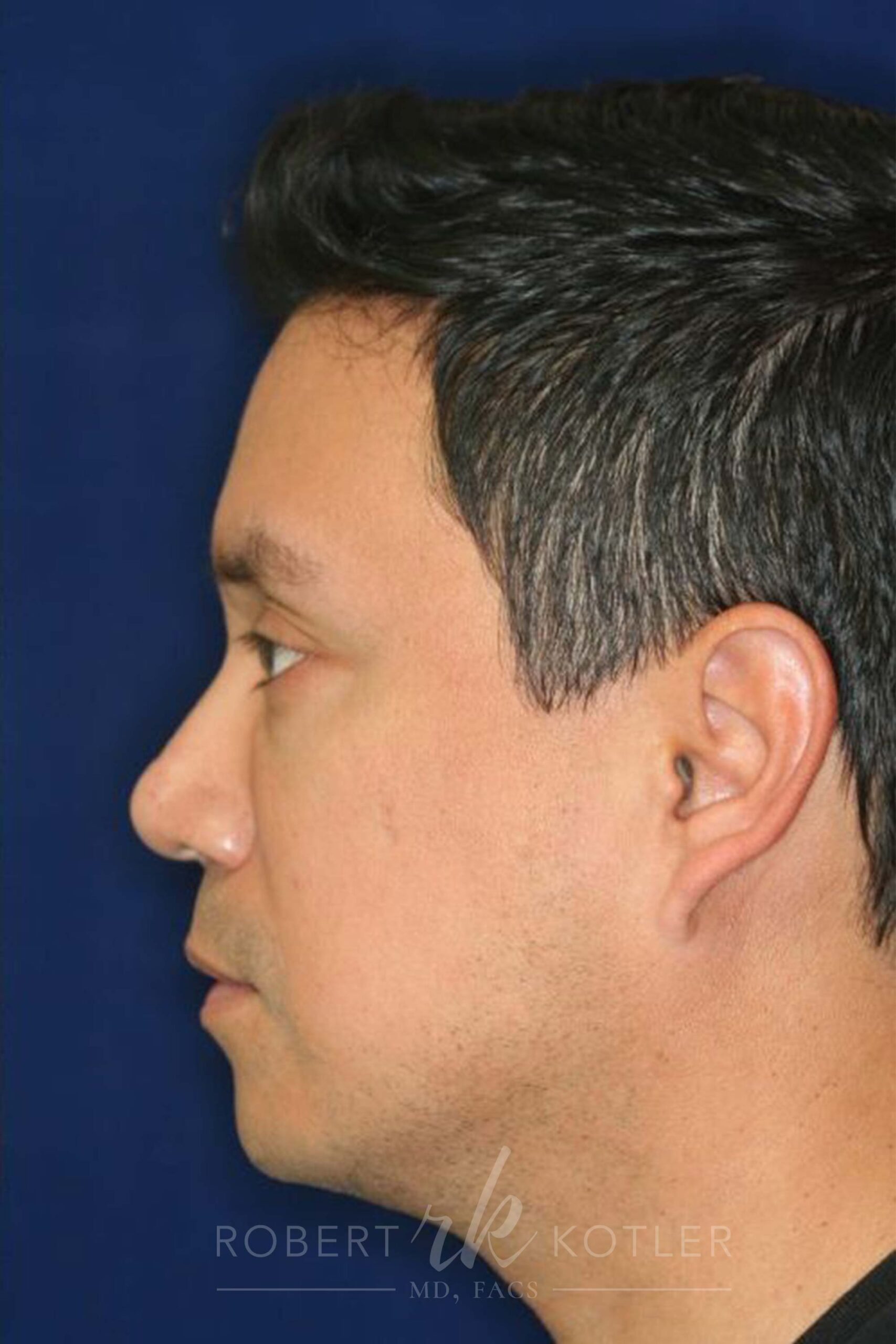Permanent Non-surgical Rhinoplasty - Left Profile - After Pic - Permanent filler - Obscuring hump - Tip refinement - Best Nose Job Surgeon