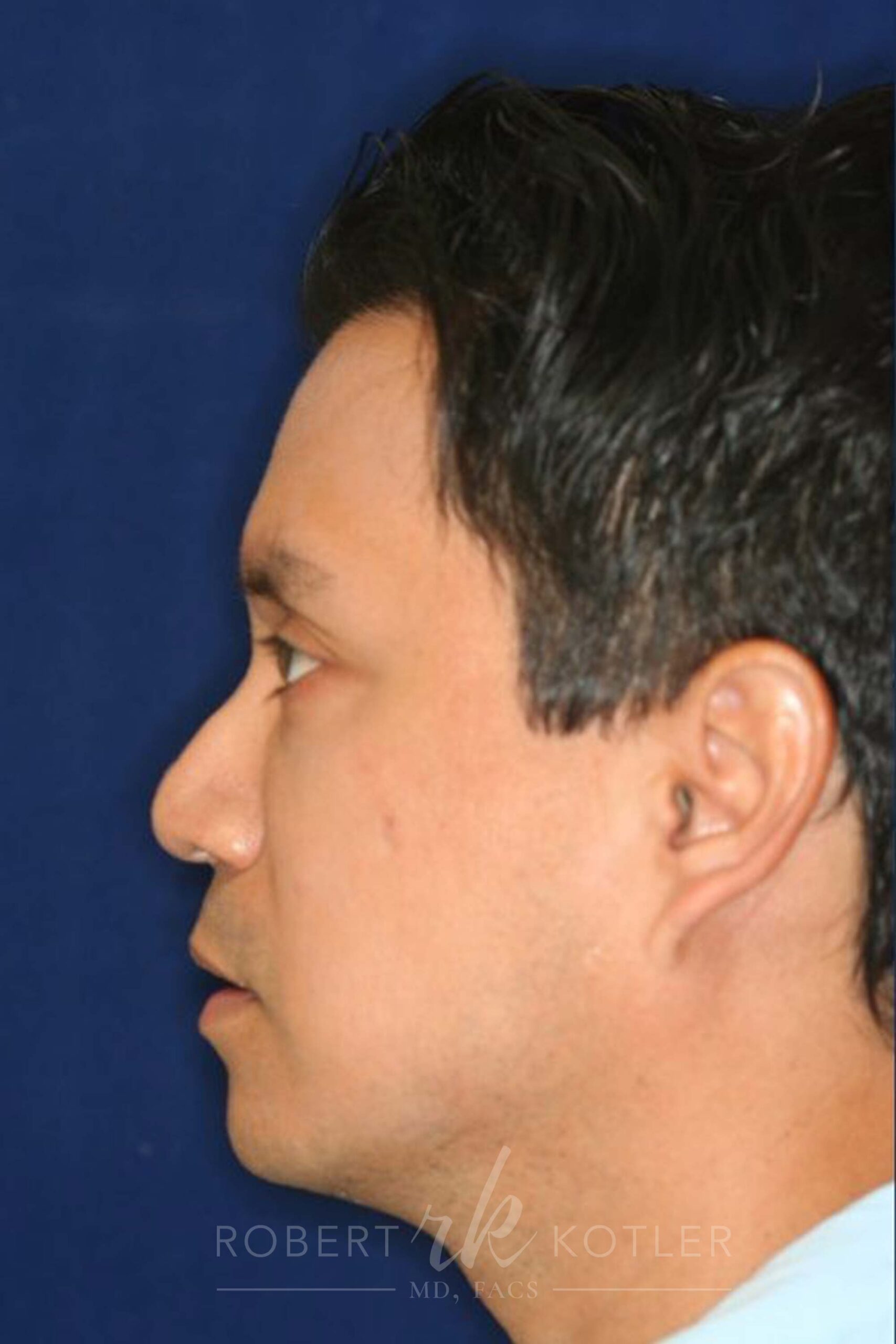 Permanent Non-surgical Rhinoplasty - Left Profile - Before Pic - Permanent filler - Obscuring hump - Tip refinement - Nose Job in Beverly Hills