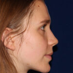 Rhinoplasty - Right Profile - Before Pic - Narrowing of the nose - narrowing of bony and cartilaginous structure - Beverly Hills Rhinoplasty Superspecialist