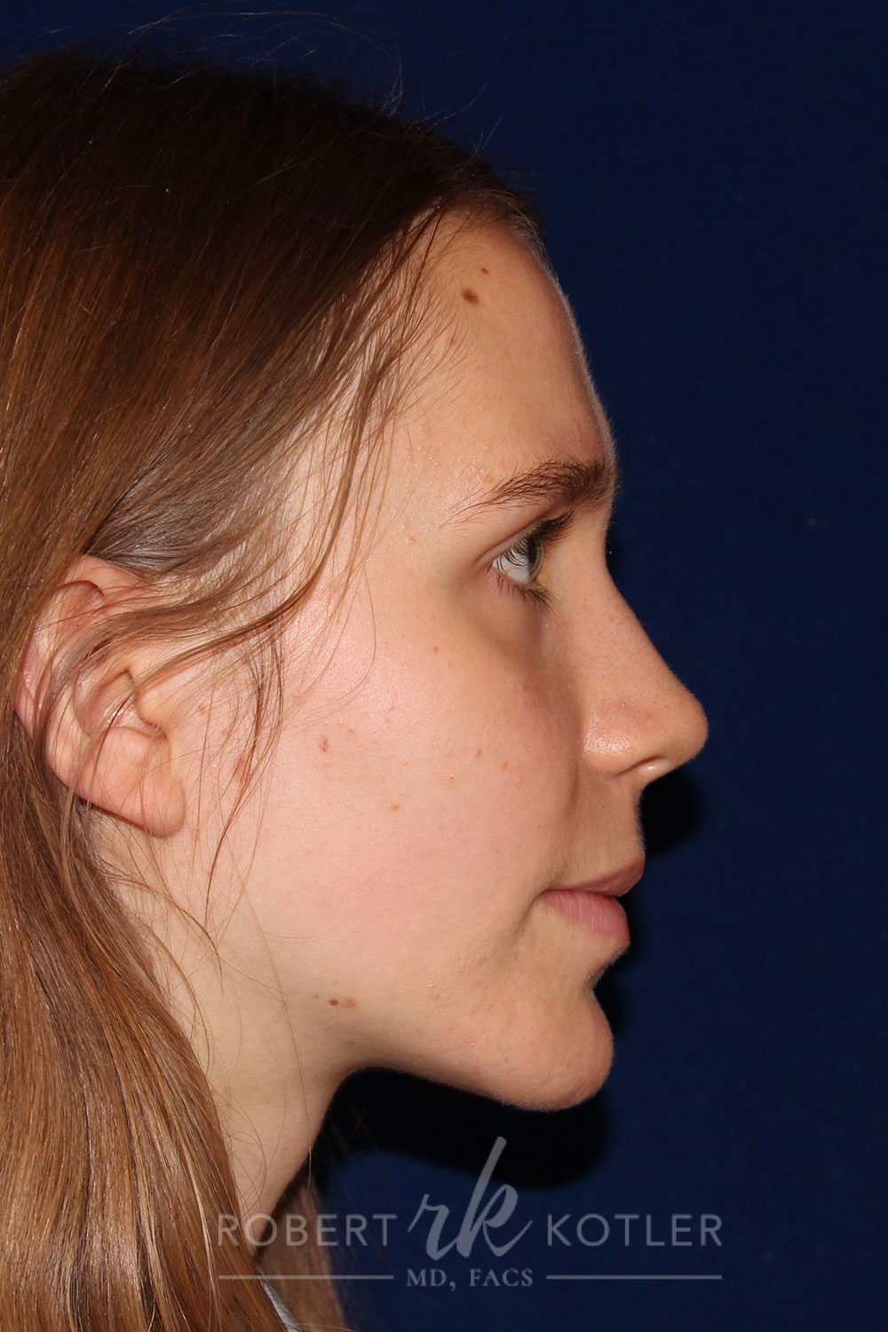Rhinoplasty - Right Profile - Before Pic - Narrowing of the nose - narrowing of bony and cartilaginous structure - Beverly Hills Rhinoplasty Superspecialist