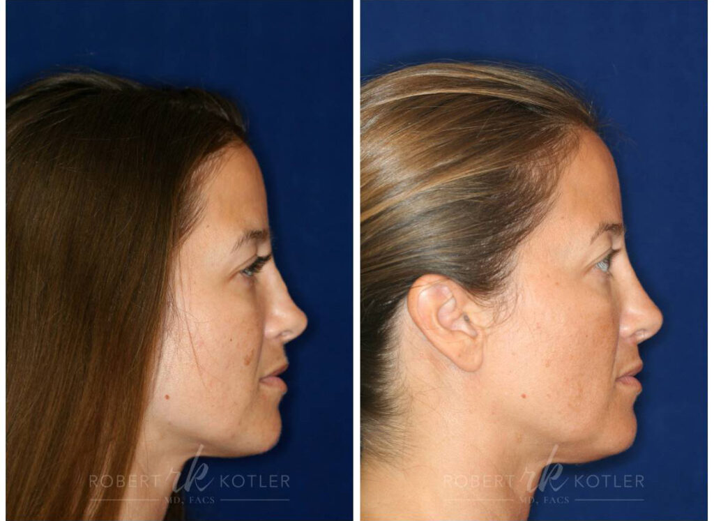 Permanent Non-surgical Revision Rhinoplasty