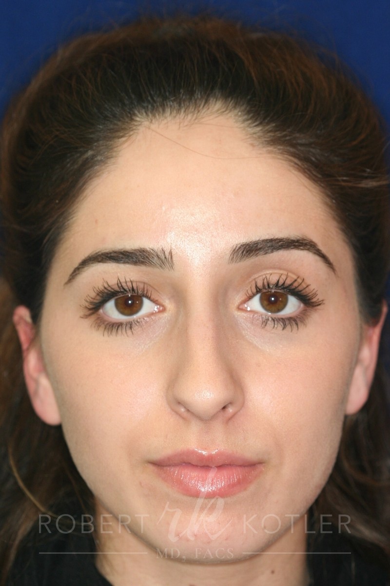 Conservative closed Rhinoplasty - Front Face view - Before Pic - Hump removal - Nose tip refinement - Best Rhinoplasty Beverly Hills