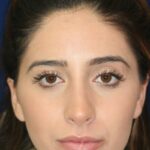 Conservative closed Rhinoplasty - Front Face view - After Pic - Hump removal - Nose tip refinement - Rhinoplasty Surgeon in Beverly Hills
