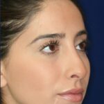 Conservative closed Rhinoplasty - Right Profile - After Pic - Hump removal - Nose tip refinement - Beverly Hills Rhinoplasty Superspecialist