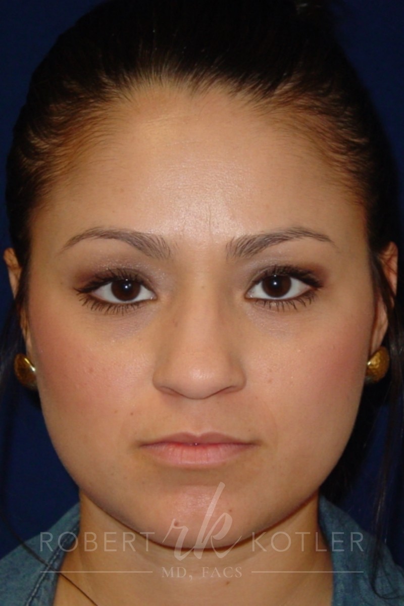 Closed Rhinoplasty - Front Face View -Before Pic - Hump removal - Tip refinement - Overall narrowing - Hanging tip elevated - Rhinoplasty Surgeon in Beverly Hills