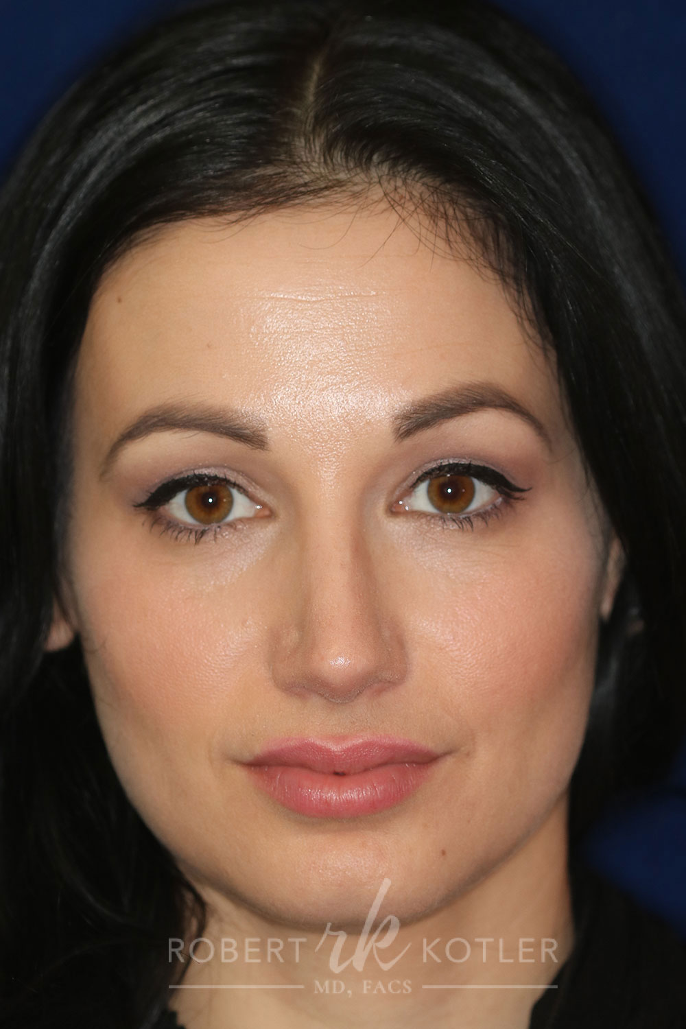 Rhinoplasty - Front Face View - After Pic - Hump removal - tip refined - Crooked nose corrected - Rhinoplasty Surgeon in Beverly Hills