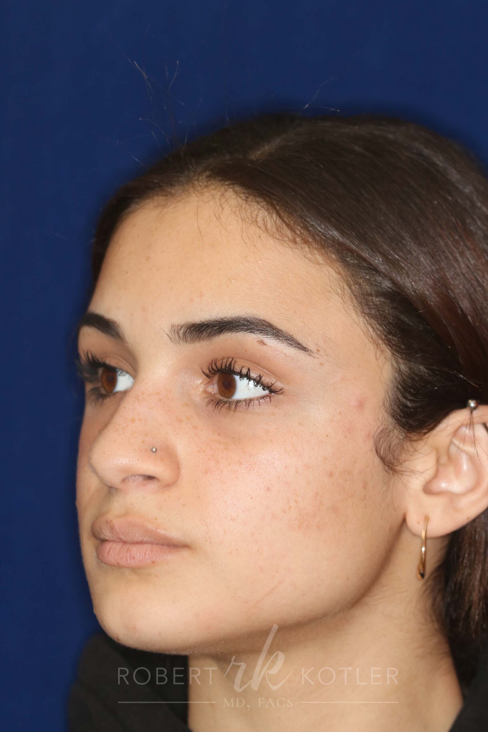 Rhinoplasty - Right Profile - Before Pic - Bump lowered - nose and lip angle slightly increased - tip refined - Rhinoplasty Surgeon in Beverly Hills