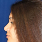 Rhinoplasty - Left Profile - After Pic - Hump removal - Nose recessed closer to the face - Nose tip refined - Top Rhinoplasty Surgeon