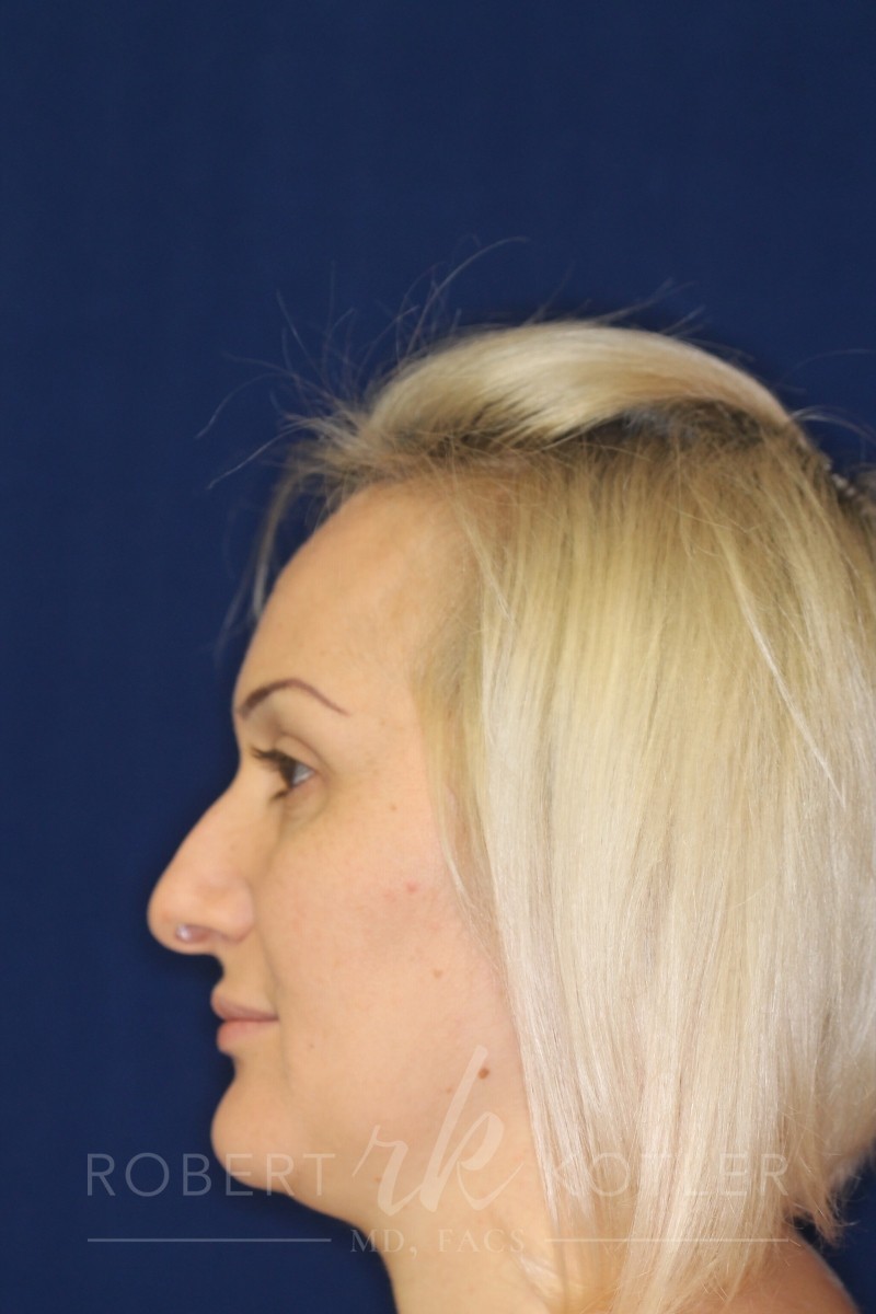 Closed Rhinoplasty - Right Profile - Before Pic - wide nose narrowing - flat nose with tip refinement -Best Rhinoplasty Beverly Hills