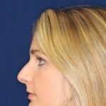 Rhinoplasty Hump removal making nose closer to the face - Before Photo Left Profile - Beverly Hills Rhinoplasty Surgeon