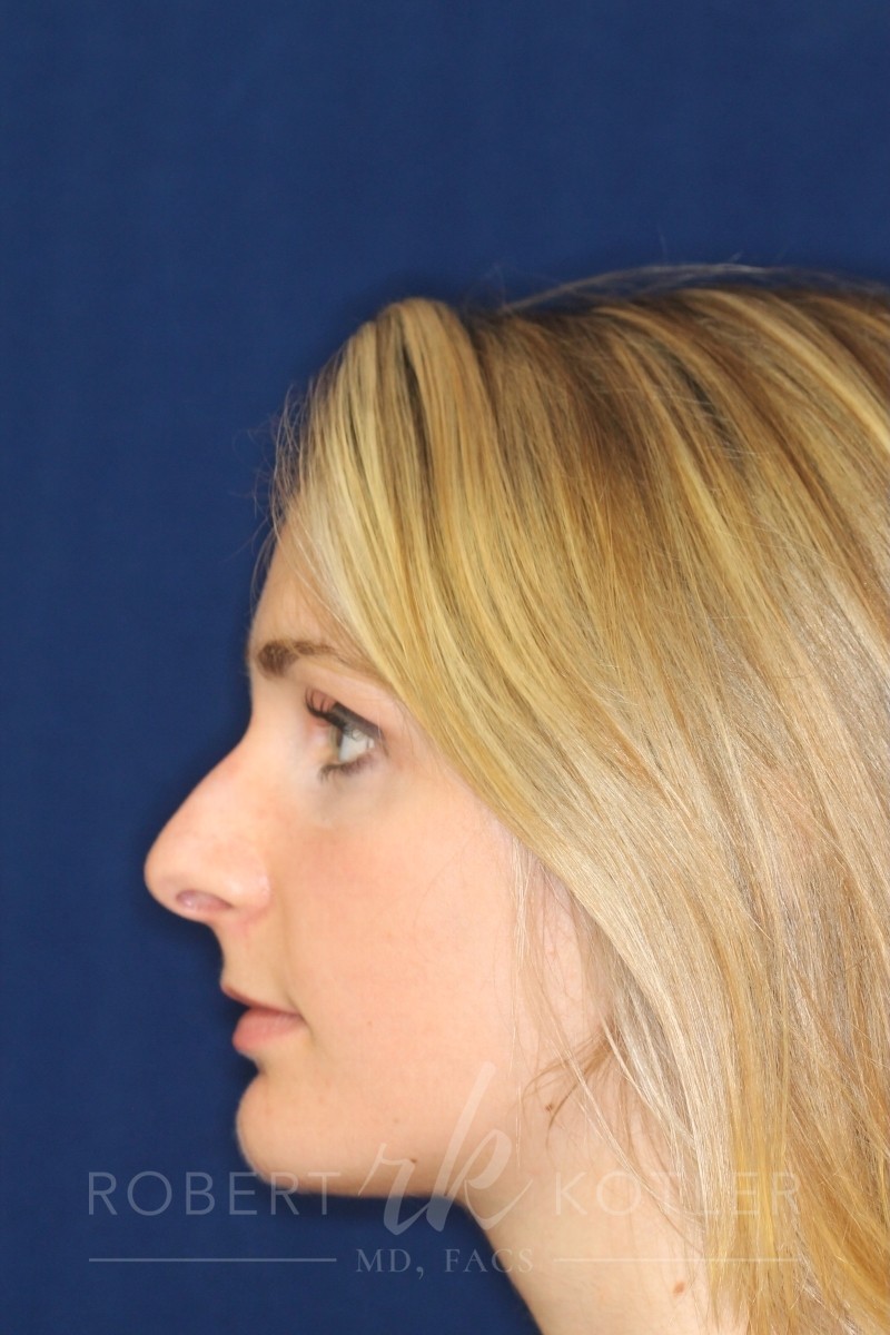 Rhinoplasty Hump removal making nose closer to the face - Before Photo Left Profile - Beverly Hills Rhinoplasty Surgeon