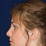 Rhinoplasty Hump removal - Left Profile - After Picture - Nose is now closer to the face - Rhinoplasty Surgeon in Beverly Hills