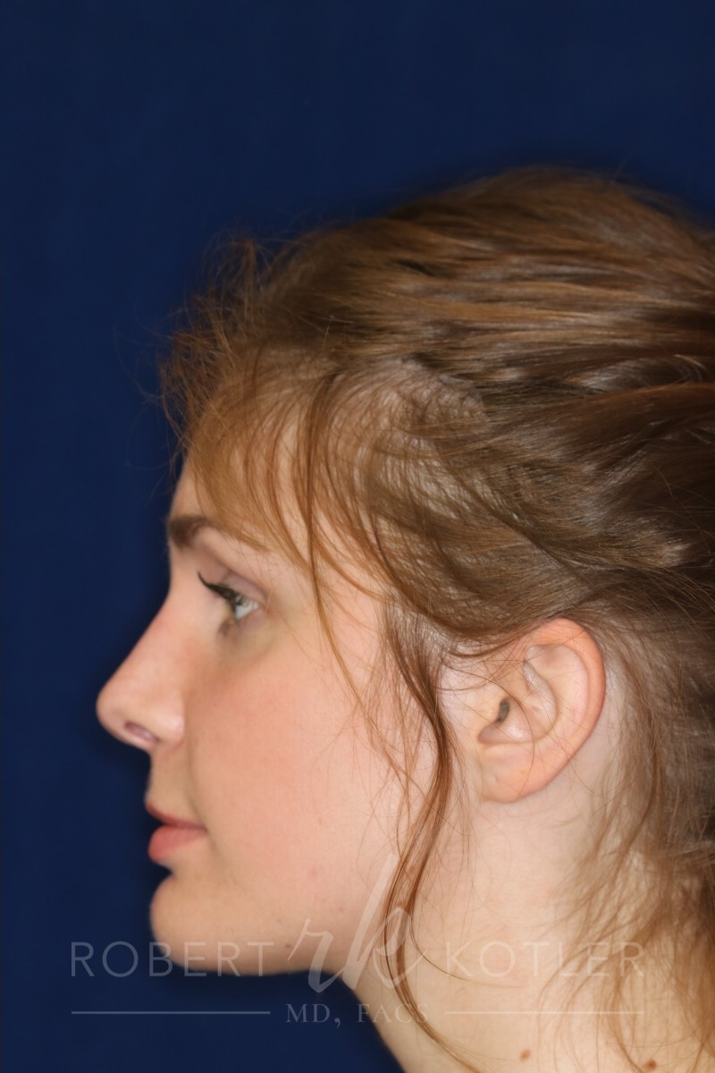 Rhinoplasty Hump removal - Left Profile - After Picture - Nose is now closer to the face - Rhinoplasty Surgeon in Beverly Hills