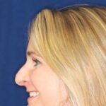 Rhinoplasty Hump removal Minor tip refinement - Before pic Left Profile - Best Rhinoplasty Beverly Hills