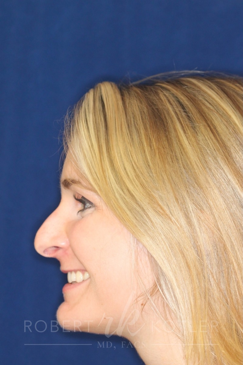 Rhinoplasty Hump removal Minor tip refinement - Before pic Left Profile - Best Rhinoplasty Beverly Hills