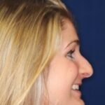 Rhinoplasty Hump Removal with a minor tip refinement - Right Profile - Before Pic - Beverly Hills Rhinoplasty Super specialist