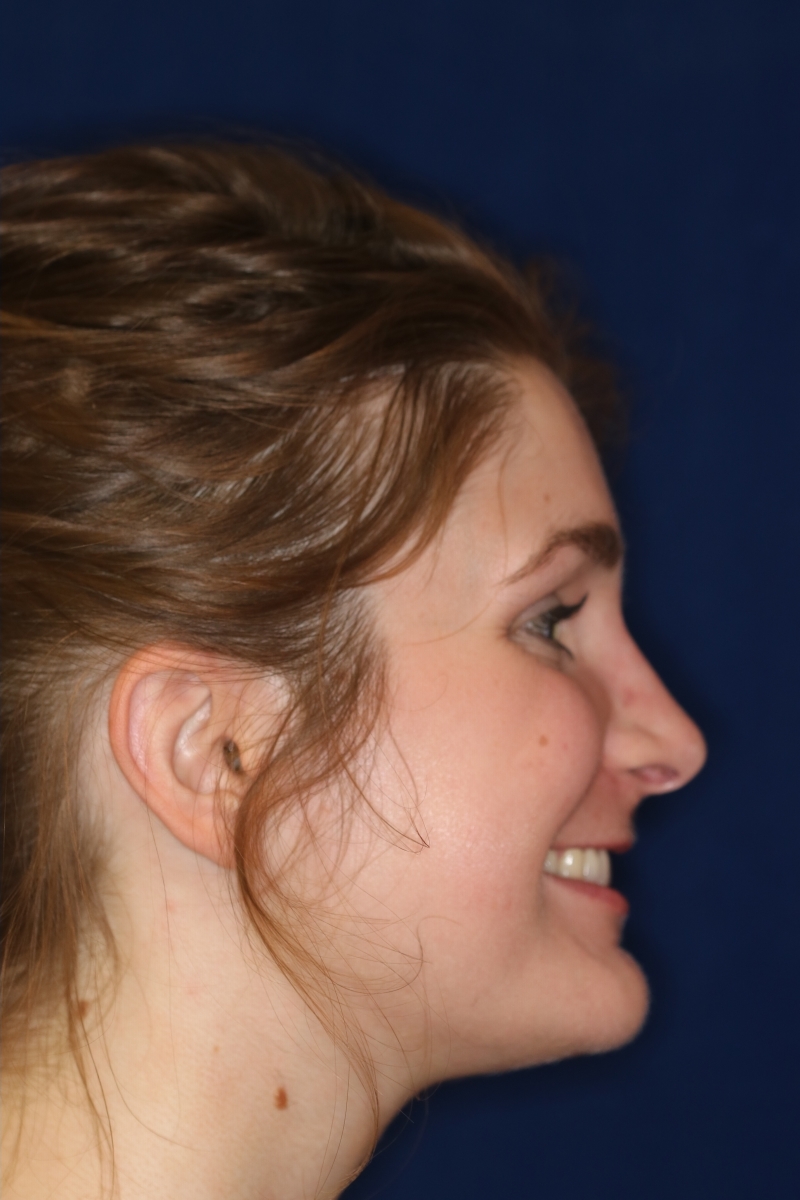 Rhinoplasty Hump Removal with a minor tip refinement - Right Profile - After Pic - Rhinoplasty Surgeon in Beverly Hill