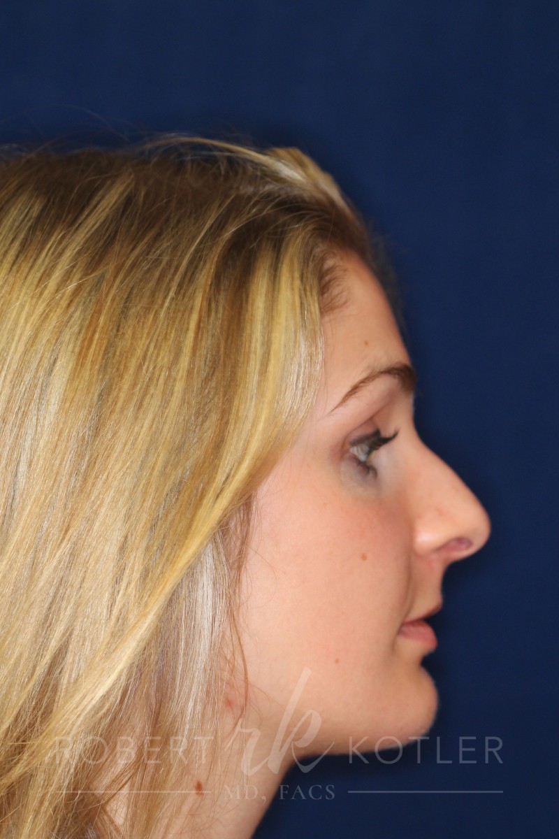 Rhinoplasty Hump Removal with a minor tip refinement - Right Profile - Before Pic - Nose Job in Beverly Hills