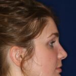 Rhinoplasty Hump Removal with a minor tip refinement - Right Profile - After Pic - Best Nose Job Surgeon