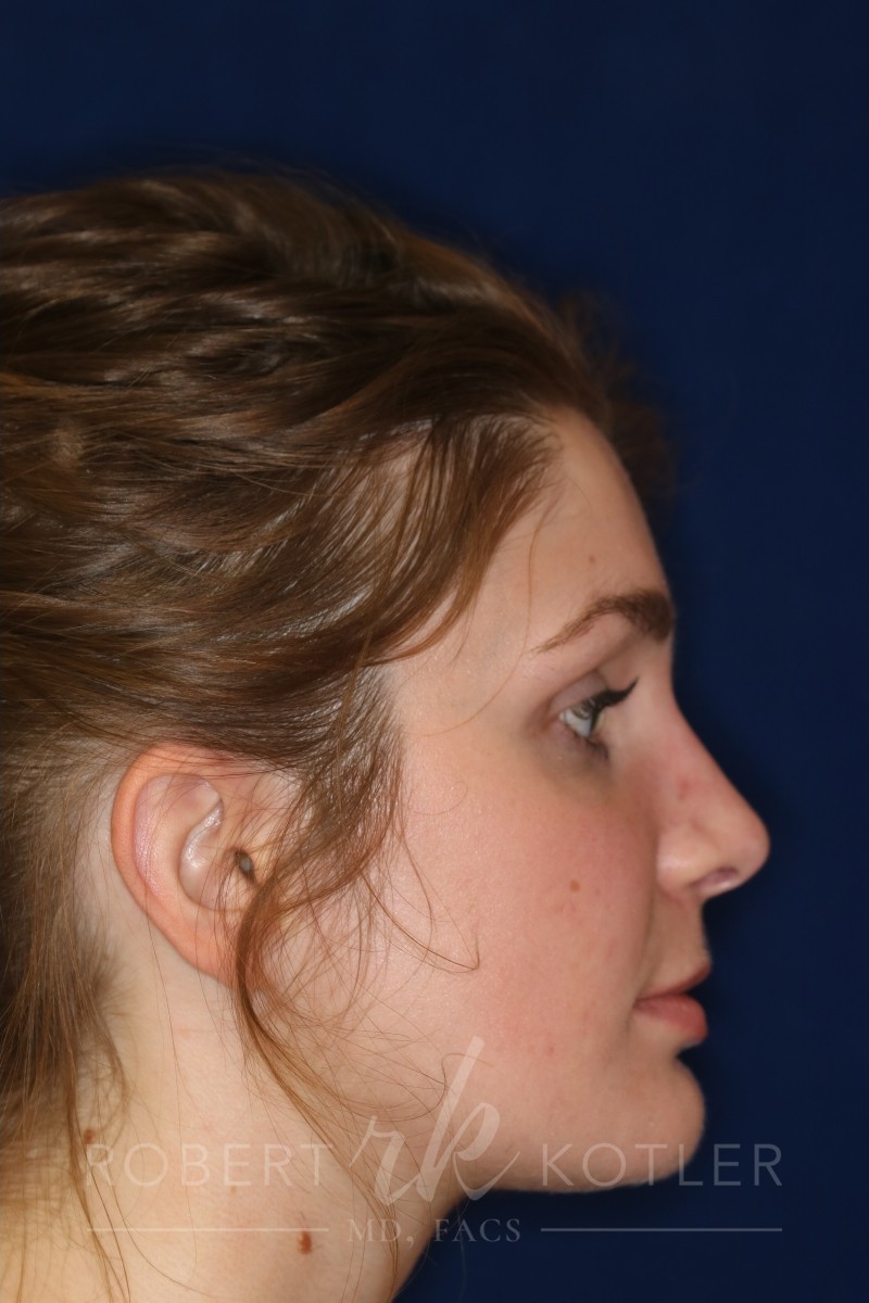 Rhinoplasty Hump Removal with a minor tip refinement - Right Profile - After Pic - Best Nose Job Surgeon