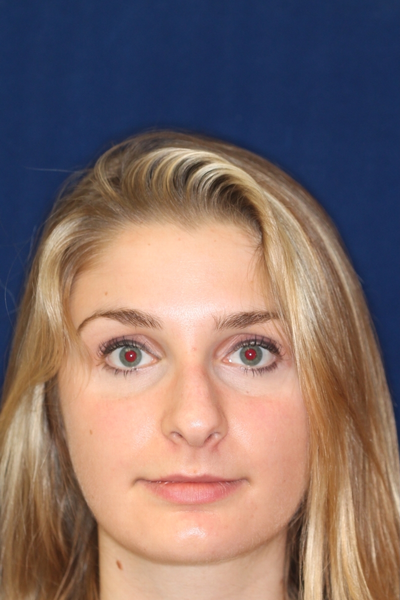 Rhinoplasty Hump Removal with a minor tip refinement - Headshot - Face - Before Pic - Top Rhinoplasty Surgeon