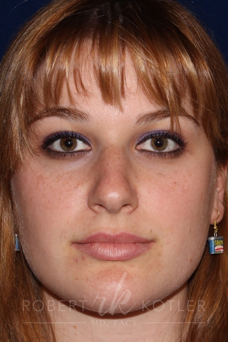 Closed Rhinoplasty - Front Face View - Before Pic - Hump Removal - Nose tip refinement - Beverly Hills Rhinoplasty Superspecialist