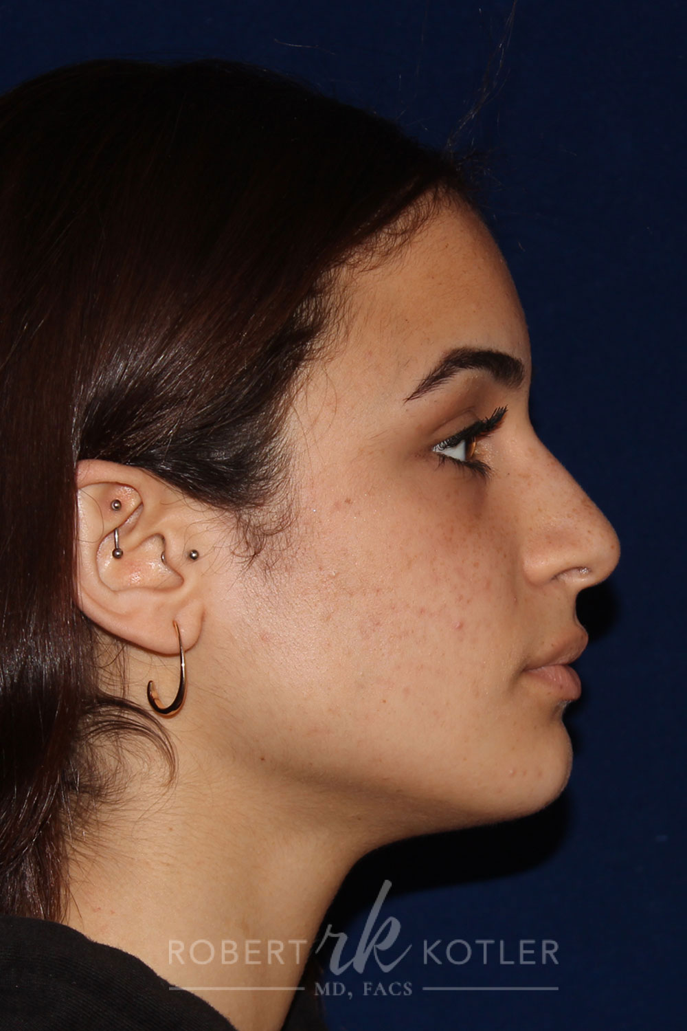 Rhinoplasty - Right Profile - Before Pic - Bump lowered - nose and lip angle slightly increased - tip refined - Rhinoplasty Surgeon in Beverly Hills