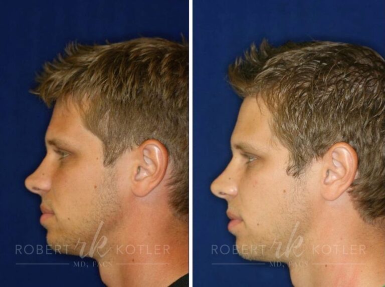 Permanent Non-Surgical nose job Photo