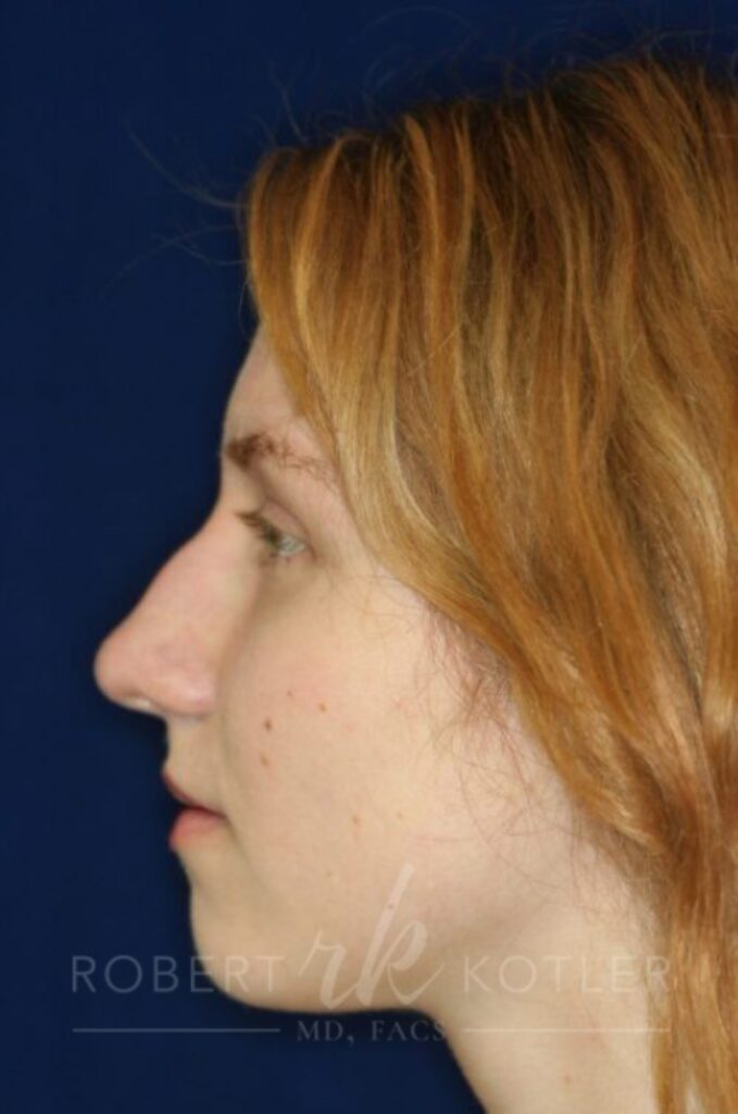 permanent-nonsurgical-rhinoplasty-nose-job-beverly-hills-ca-1458-a