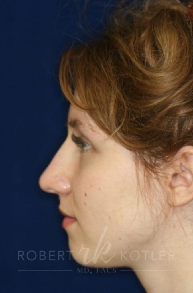 permanent-nonsurgical-rhinoplasty-nose-job-beverly-hills-ca-1459-b