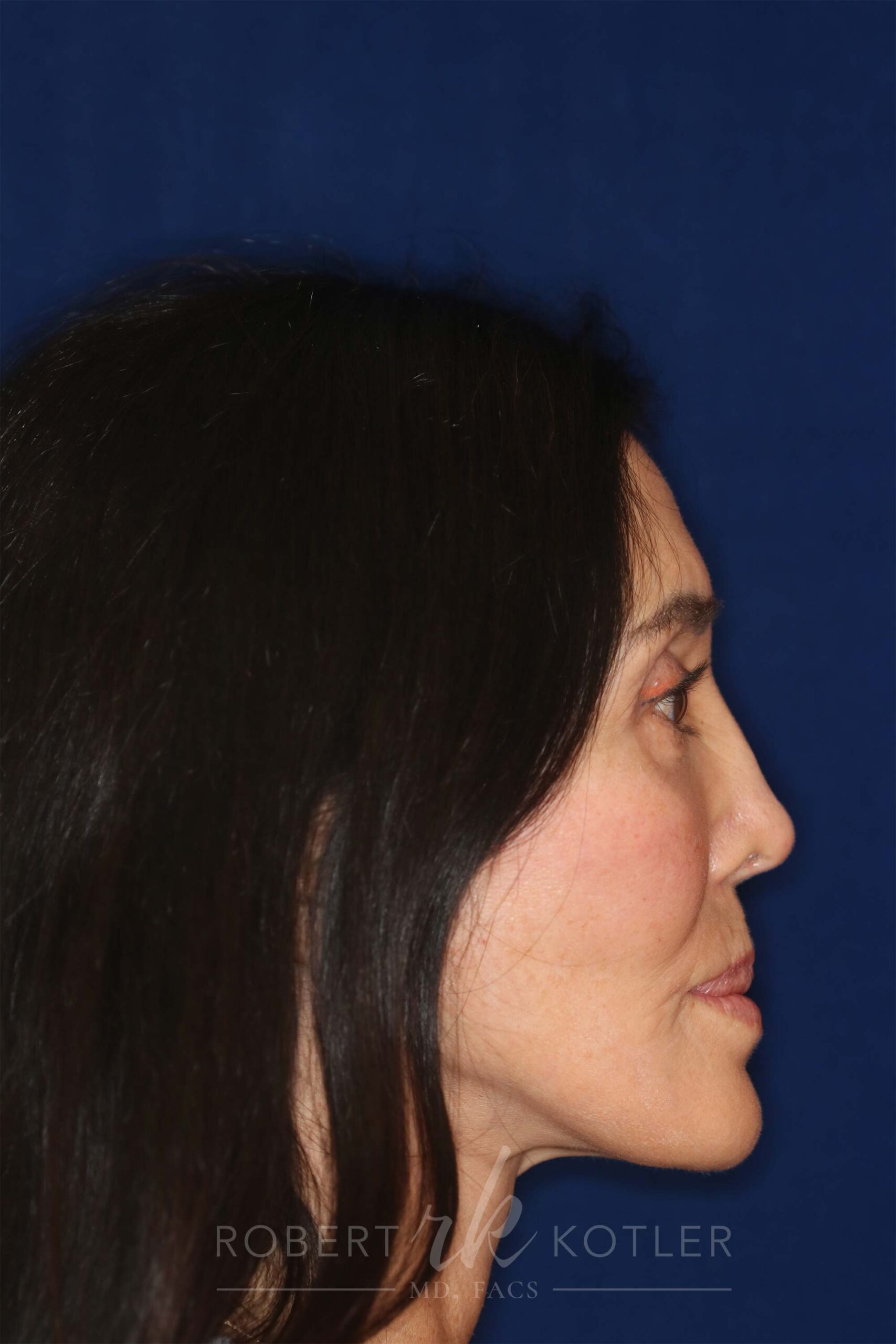 Permanent Non-Surgical Revision Rhinoplasty