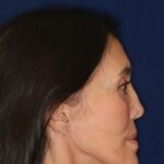 Permanent Non-Surgical Revision Rhinoplasty