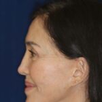 Permanent Non-Surgical Revision Rhinoplasty