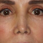 Permanent Non-Surgical Revision Rhinoplasty