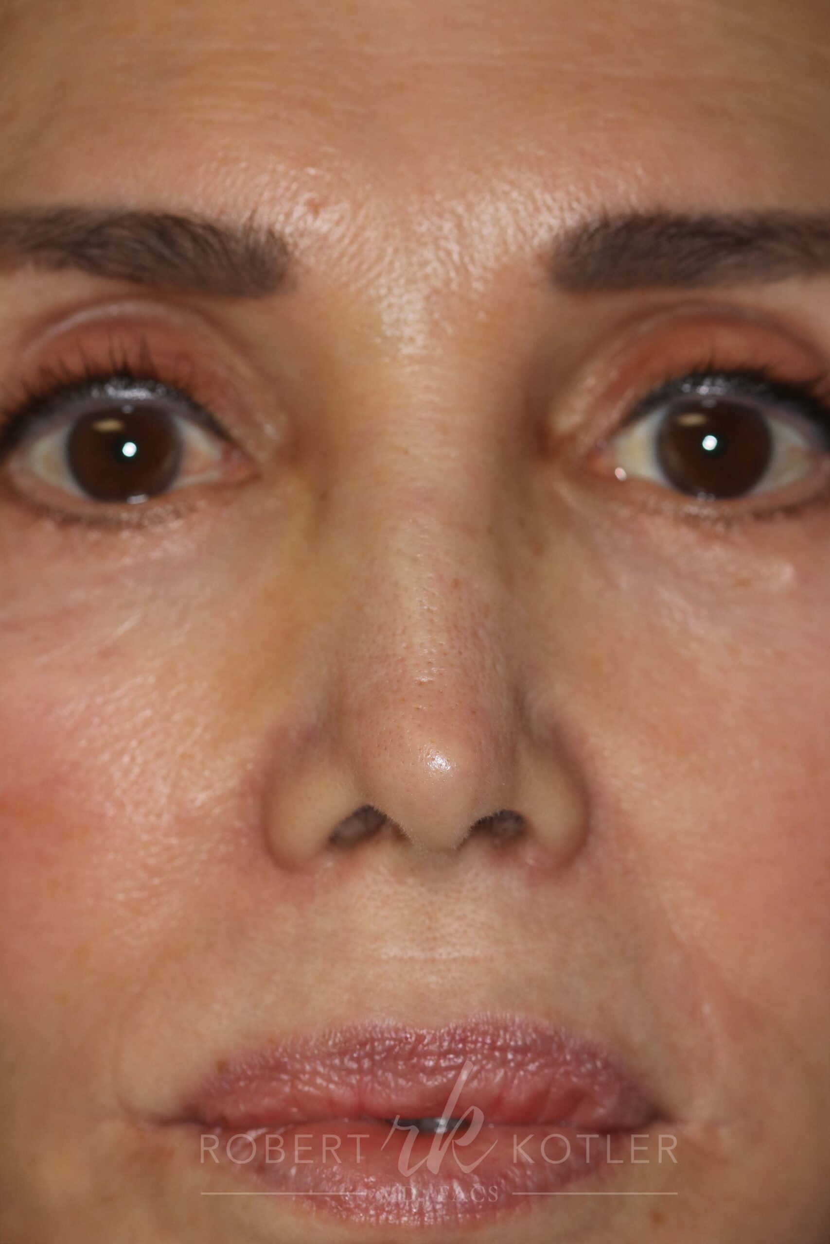 Permanent Non-Surgical Revision Rhinoplasty