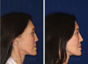 Non-surgical Nose Job After Rhinoplasty (Non-surgical Revision)