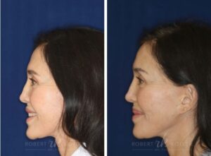 Non-surgical Nose Job After Rhinoplasty (Non-surgical Revision)